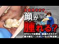 顔腫れ、ズキズキ歯が痛む！セラミック治療後になぜ？