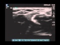 Scanning Technique Video: Peripheral Arm Veins for Vascular Access with Ultrasound