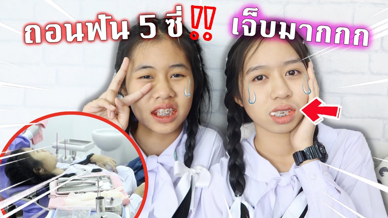 ถอนฟัน พร้อมกัน 5 ซี่‼️ เพื่อจัดฟัน จะเจ็บแค่ไหนกัน⁉️ พี่วาวาพี่วาวจัดฟัน | WiwaWawow TV