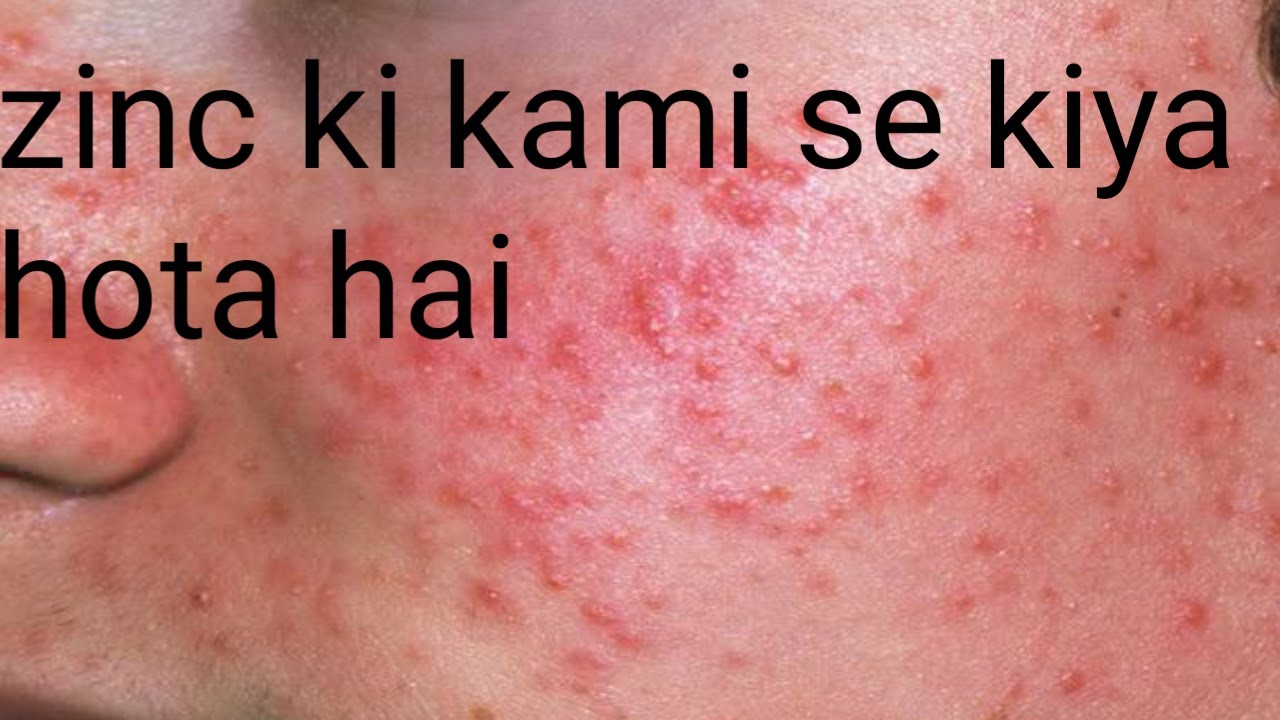 zinc ki Kami Se Kya Hota Hai pimple ko kaise kam Karen balon ko jhadane