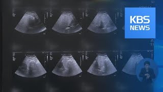 ‘지방간은 간 문제?’…당뇨 발생 위험 80%↑ / KBS뉴스(News)