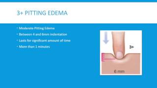 Pitting Edema Grading Scale 4 Levels