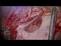 COCHLEAR IMPLANTATION IN MUMBAI - DR.MEENESH JUVEKAR