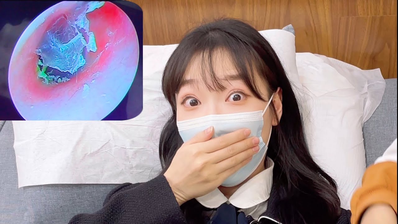 귀에서 나온 초대형 귀지... 이건 진짜 레전드다!