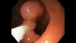 Resection of a pedunculated gastric polyp.