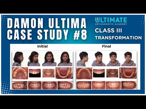 14 Month Class III Transformation: Damon Ultima Case Study #8