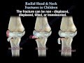 Radial Head & Neck Fractures In Children - Everything You Need To Know - Dr. Nabil Ebraheim