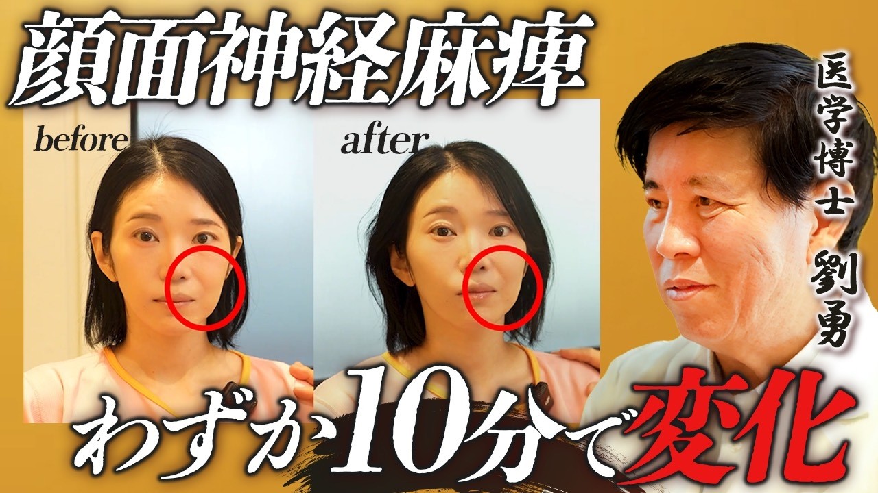 まさか自分が重度の顔面神経麻痺に…短時間で変化が出た鍼治療とは