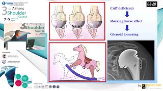 Complications of anatomic and reverse TSA - Miltiades K. Ziogas