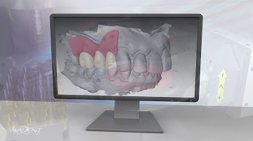 Removable Partial Denture