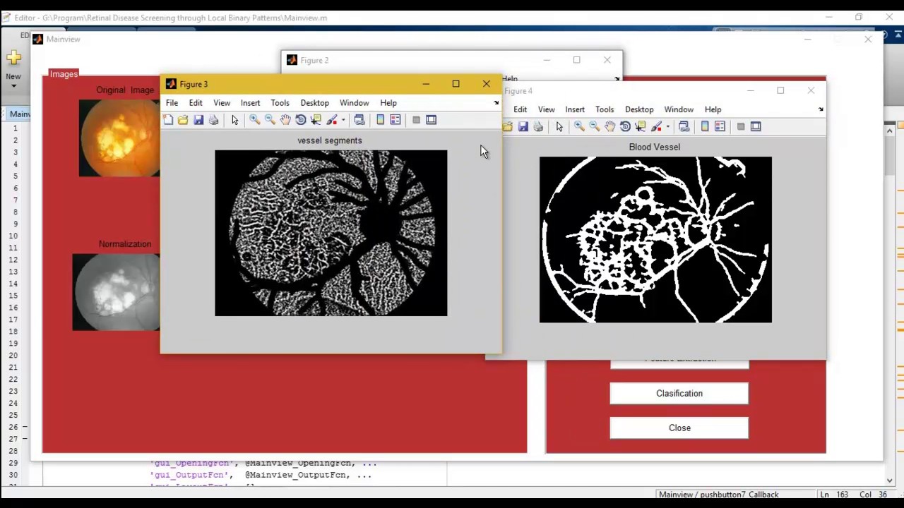 Retinal Disease Screening through Local Binary Patterns matlab projects ...
