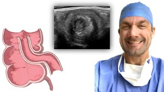 Diagnosing Intussusception