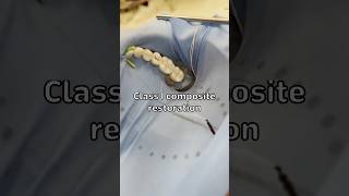 Class 1 composite restoration- Dental School