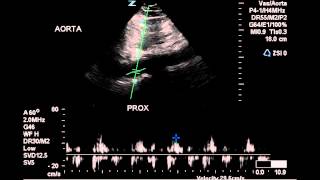 Duplex of an Aortic Dissection - Case Study