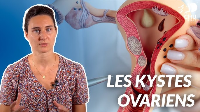 Kystes et grossesse - YouTube