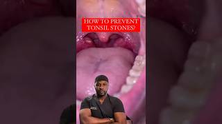 What Are Tonsil Stones Made Of? 🤔💎 #shorts