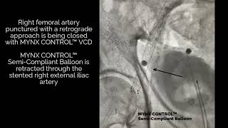MYNX CONTROL™ VCD  Semi Compliant Balloon under fluoroscopy