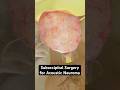 Removing a tumor from your ear (3D Animation)