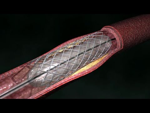 Video: ¿La colocación de stent es un procedimiento quirúrgico?