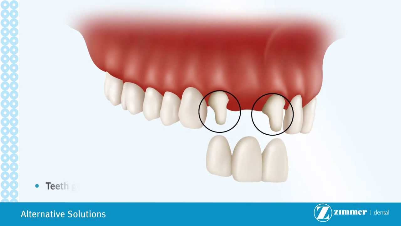 Alternative Treatment Options for Dental Implants and Denture Bridges YouTube