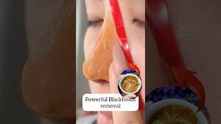 nose blackhead and Whitehead removing at home remedy#shorts #youtubeshorts #trendinghacks #short