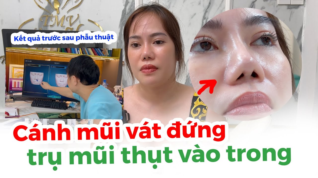Bác Sĩ Huy Chữa Mũi Khó: Trụ Thụt, Cánh Mũi Vát Đứng  Nâng Mũi Sụn Sườn Sóng 3D Signature