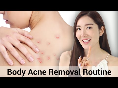 Body Acne Treatment | Summer Essentials | Wishtrend