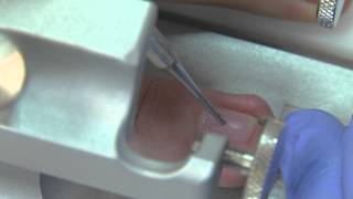 Podoexpert - Lesson3 - Fingernail Ingrowth