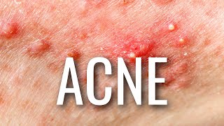The REAL Reasons You Have Acne Details