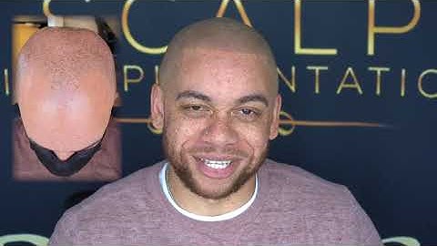 Scalp Micropigmentation (HAPPY CLIENT) Testimonial @TheARTofSMP
