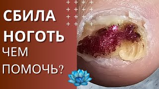 Травма ногтя. Эффективное лечение у подолога.