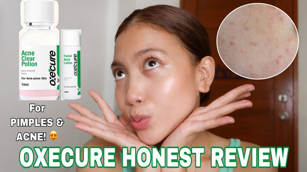 OXECURE PRODUCTS HONEST REVIEW The best for Acne ️ Acne Clear Potion
