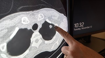 Saving Lives with AI: 30% More Accurate Lung Cancer Screening with AI CT Scan Tech