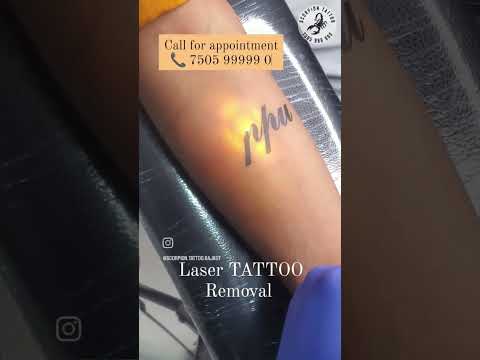 Laser TATTOO Removal