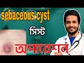 সিস্ট অপারেশন | সেবাসিয়াস সিস্ট | sebaceous cyst operation |tumour | Dr. Sanowar Hossain