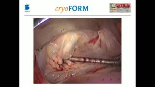 15.40-16.06: Concomitant Ablation: Endocardial, Nicolas Doll, MD