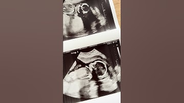 Excited for december: identical twins thriving! #twins #identicaltwins