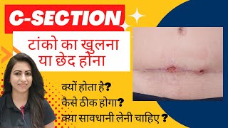 सिजेरियन के बाद टांको का खुलना या छेद होना । Hole or opening in stitches after C-Section