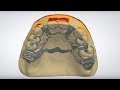 3shape dental system  rpd with metal backing metal dummies and virtual teeth
