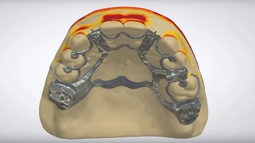 3Shape Dental System - RPD with Metal Backing, Metal Dummies and Virtual Teeth