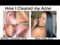 I cleared my Acne using Carbolic Soap & Shea Butter -  Morning & Night Routine