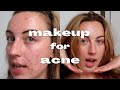 LIGHT COVERAGE MAKEUP FOR ACNE + SCARS / grwm