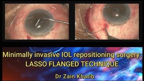 Minimally invasive subluxated IOL refixation surgery: Lasso flanged technique, Dr Zain Khatib