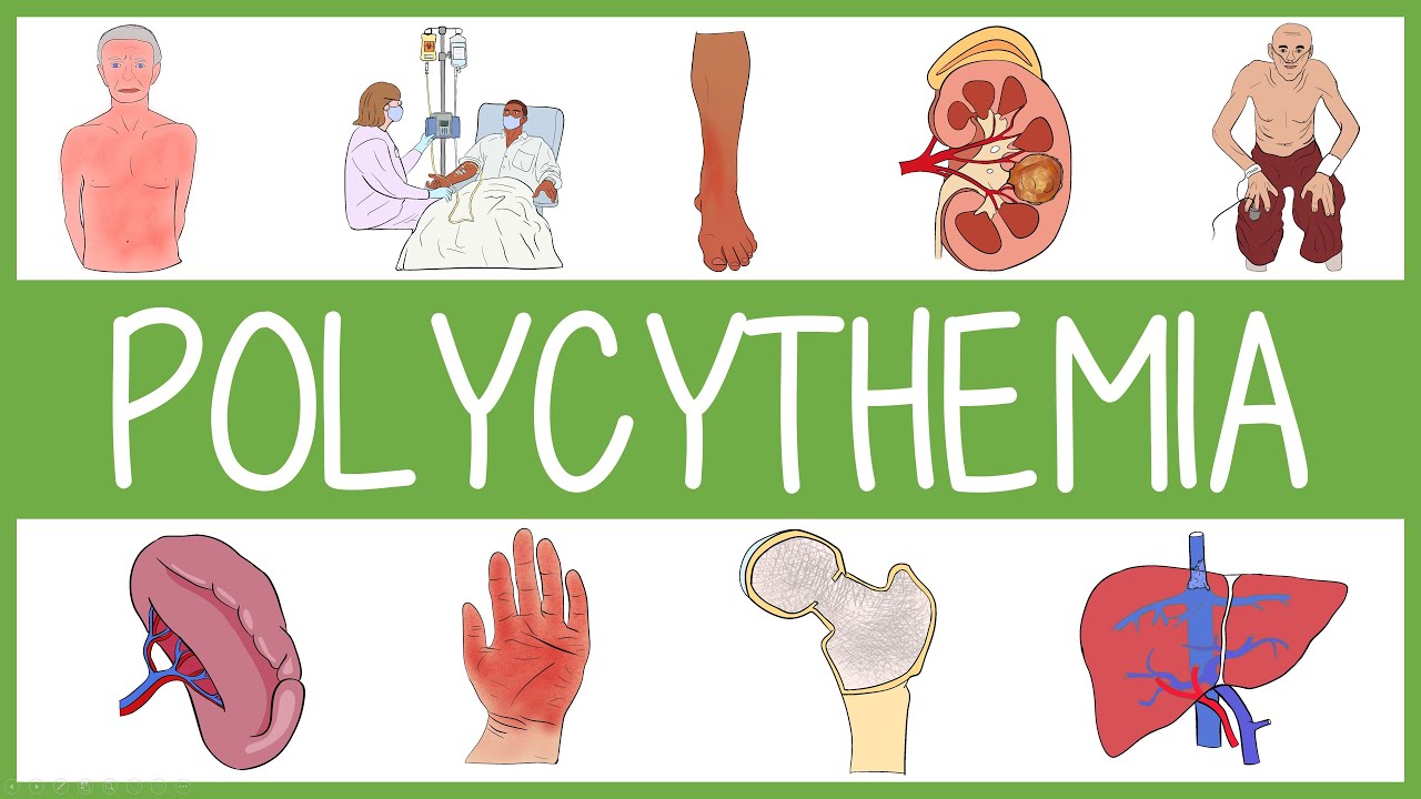 polycythemia