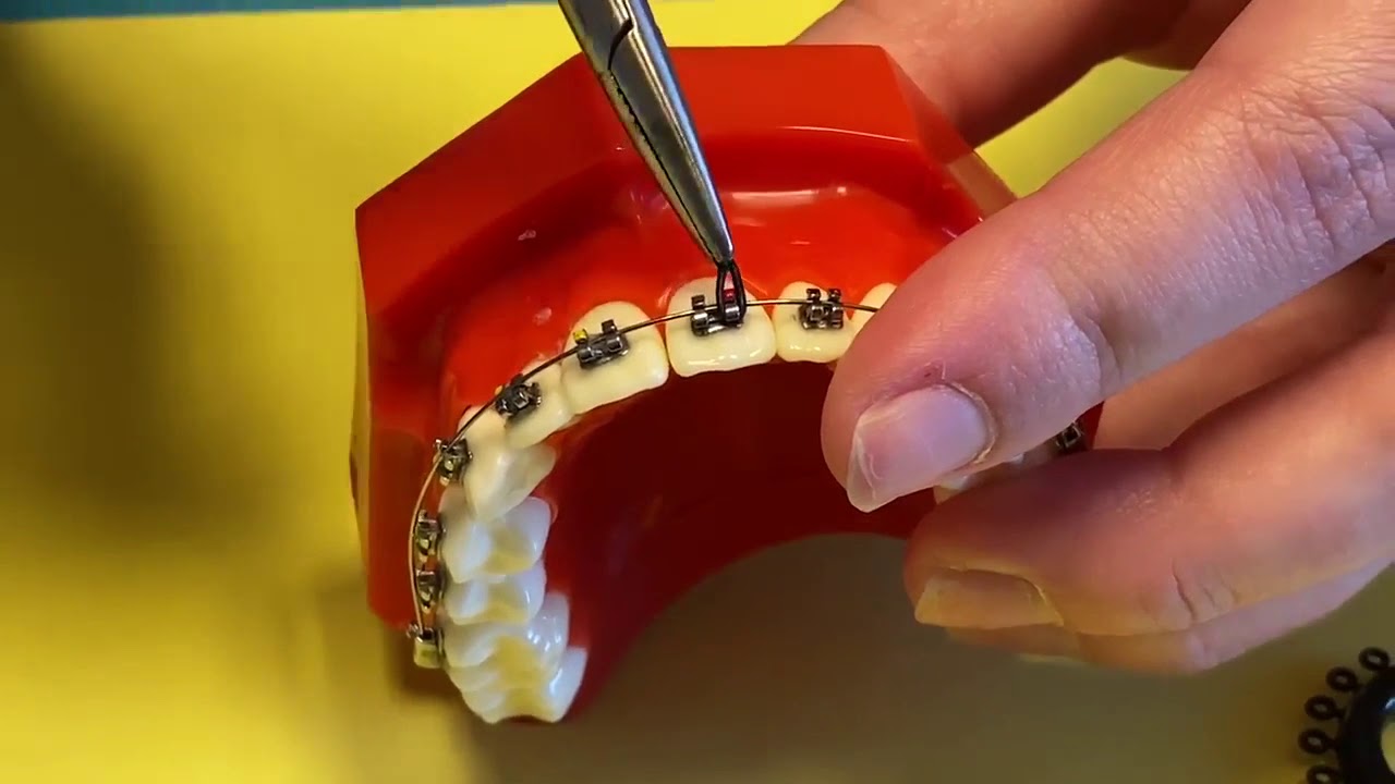 Braces on - How to put in rubber bands at home - Tooth Time Family  Dentistry New Braunfels 