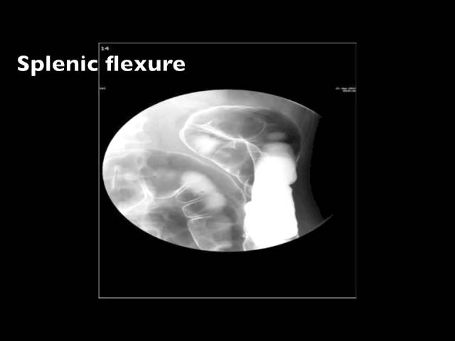 Barium Enema Double Contrast Fluoro --- Step by Step Instructions class=