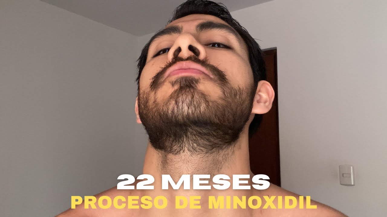 22 MESES USANDO MINOXIDIL PARA CRECER BARBA (SIENDO 100% LAMPIÑO)