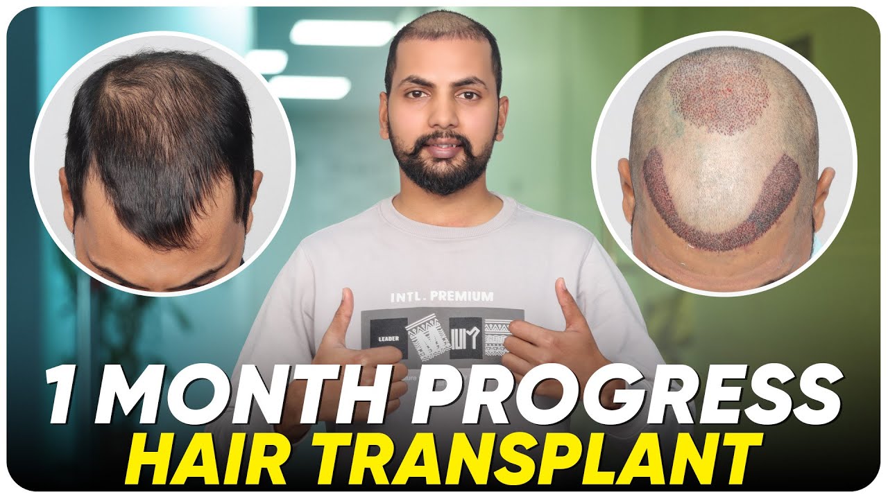 Hair Transplant in Asansol Best Results & Cost of Hair Transplant in