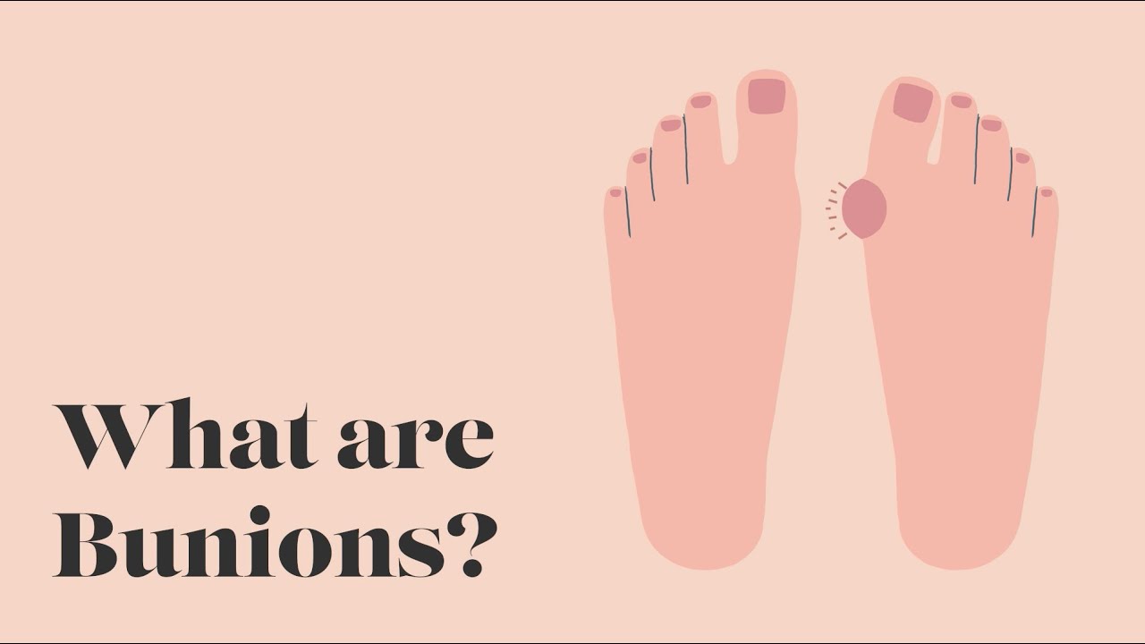 What are Bunions? Keep On Walking YouTube