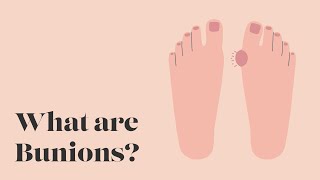 What are Bunions? | TheWalkingCompany | Keep On Walking